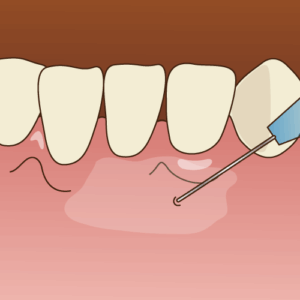 歯科麻酔の様子