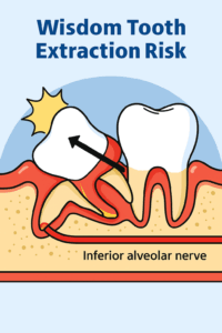 下歯槽神経と近接する横向きの水平埋伏智歯